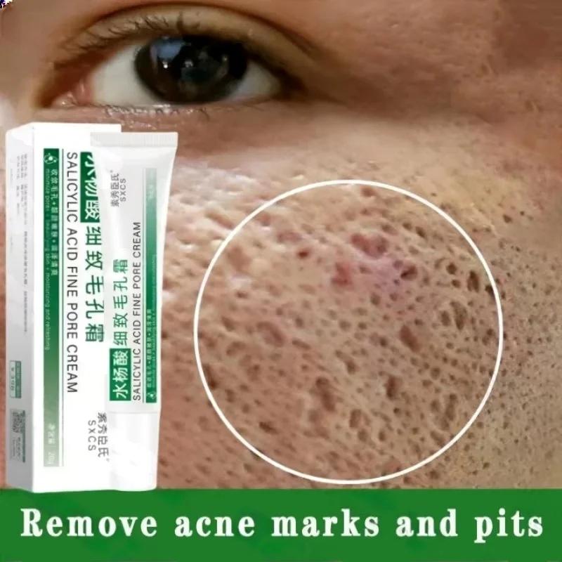 Azelaic Acid Cream - Salicylic Acid Pore Clearing Cream Shrink