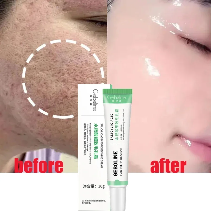 Azelaic Acid Cream - Salicylic Acid Pore Shrinking Cream Quick
