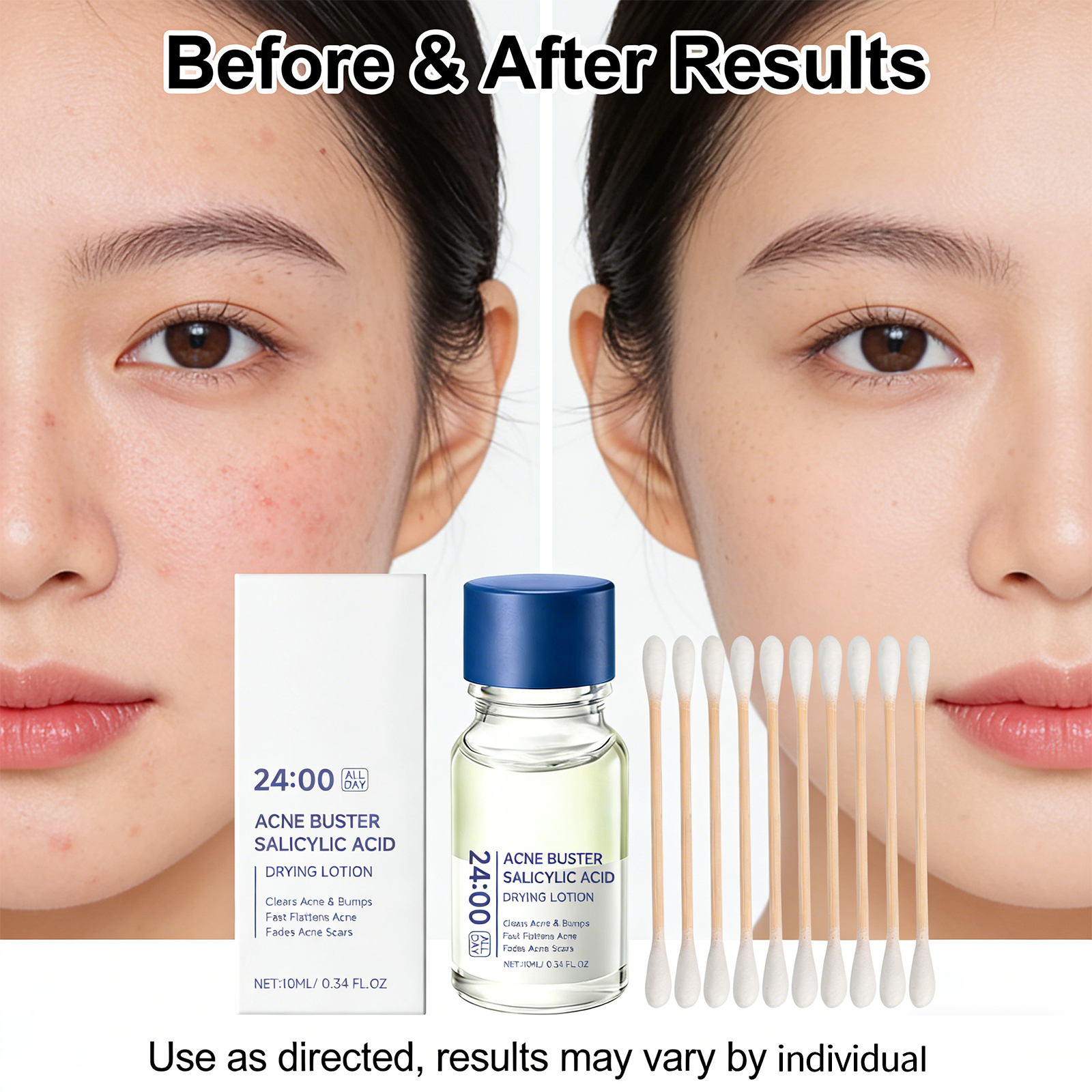 Salicylic Acid Drying Lotion A - Azelaic Acid Cream recension och pris