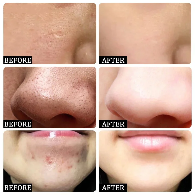 Salicylic Acid Pore Clearing C - Azelaic Acid Cream recension och pris