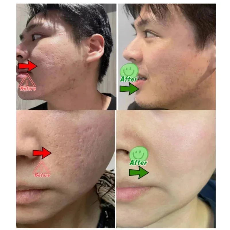 Salicylic Acid Pore Clearing C - Azelaic Acid Cream recension och pris