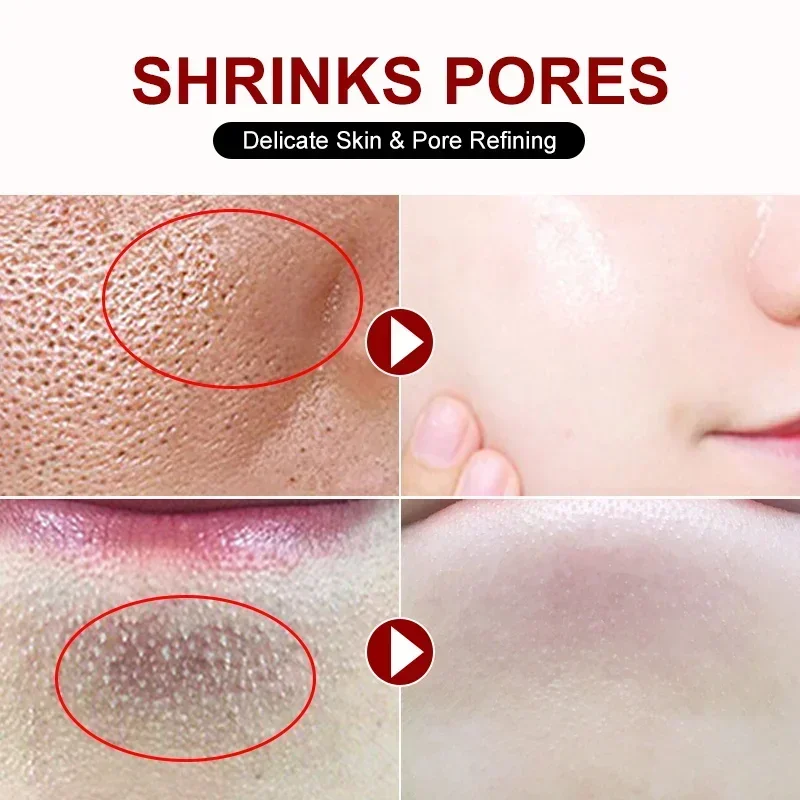 Salicylic Acid Pore Shrinking  - Azelaic Acid Cream recension och pris