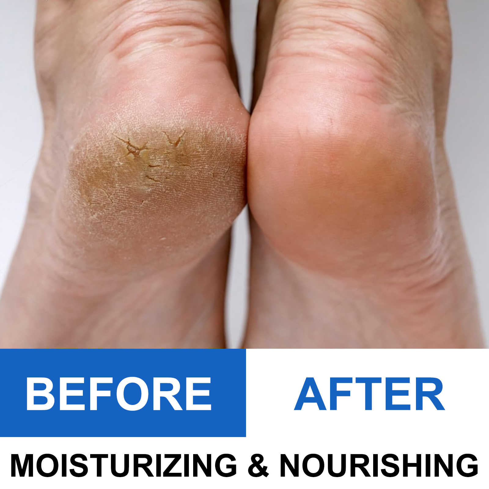 40% Urea Foot Cream Stick - Mo - Azelaic Acid Cream recension och pris